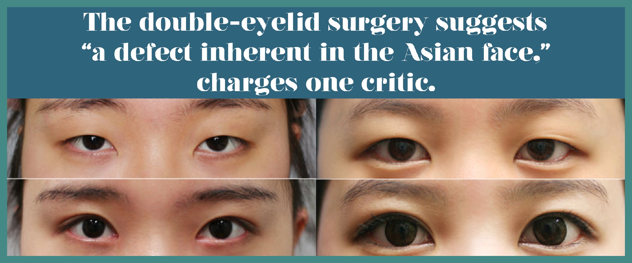 Korean eye widening clearance surgery